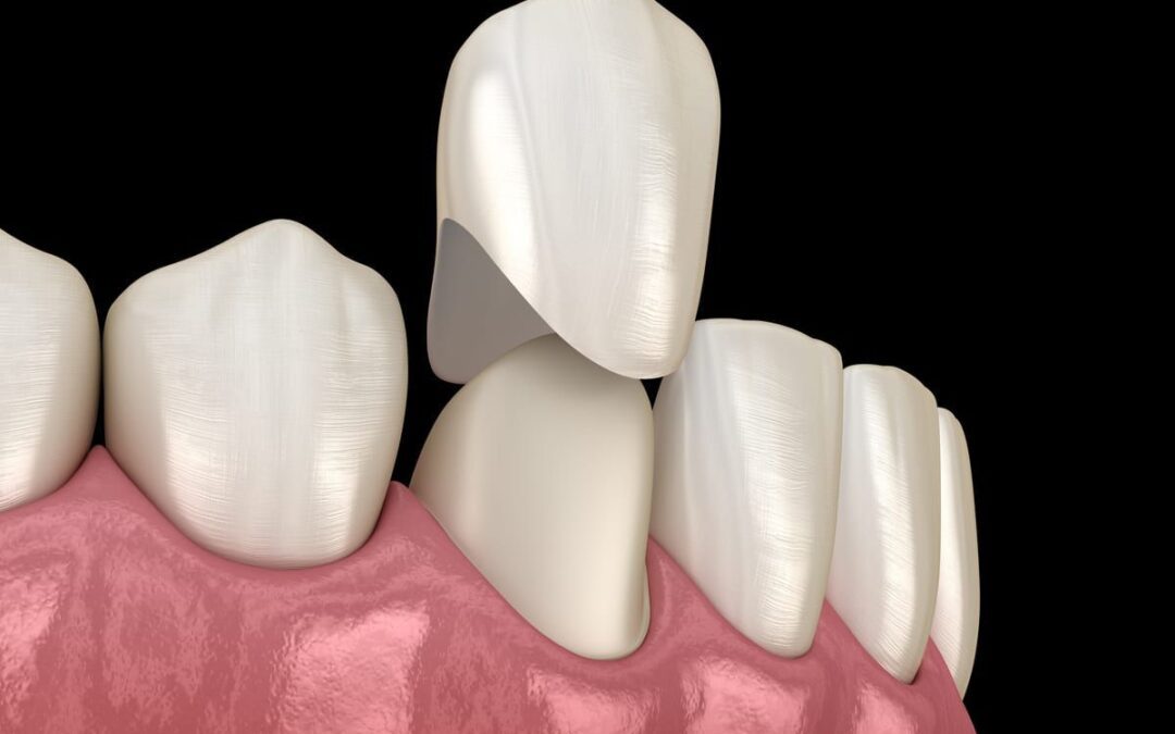 Porcelain Crowns