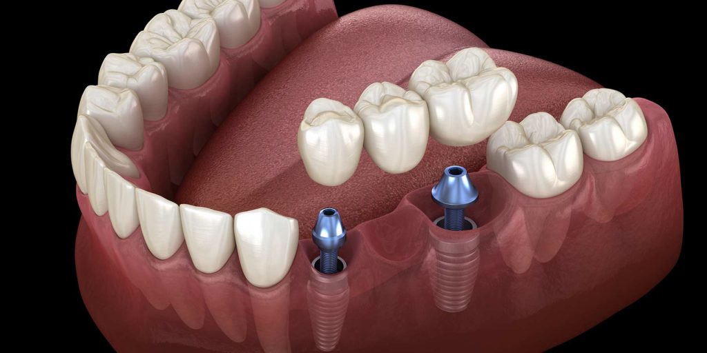 Dental Bridges